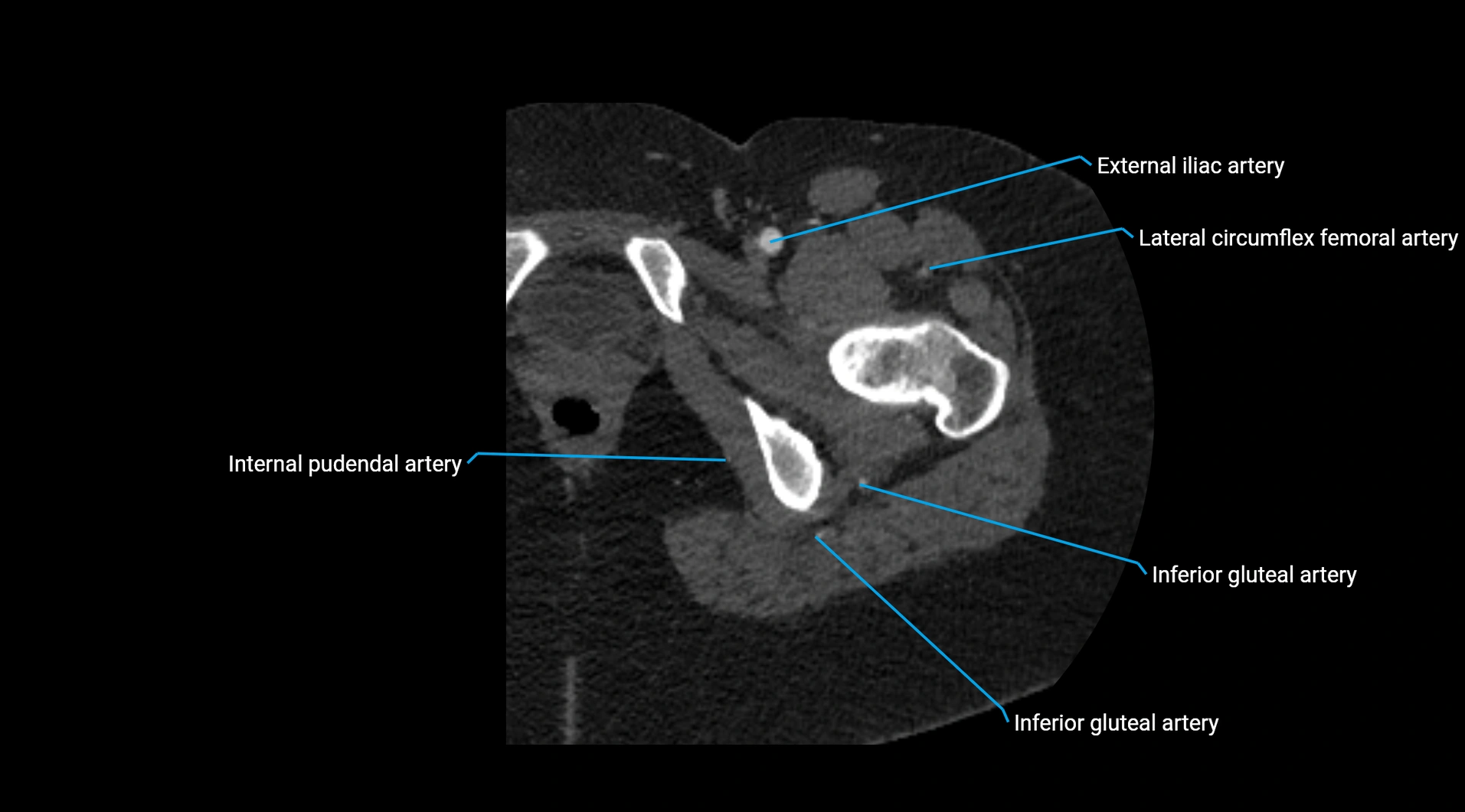 CTA lower limb cross sectional anatomy labelled image _63.webp